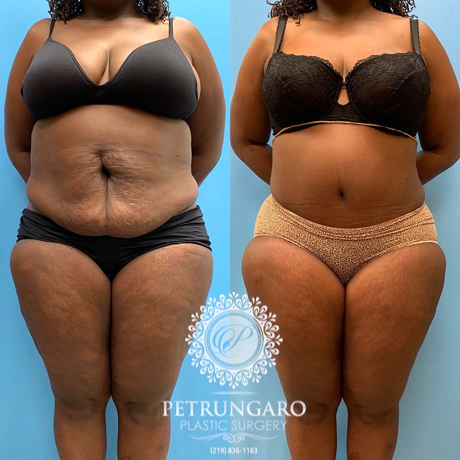49 year old woman 4 months after Tummy Tuck with Lipo 360-1