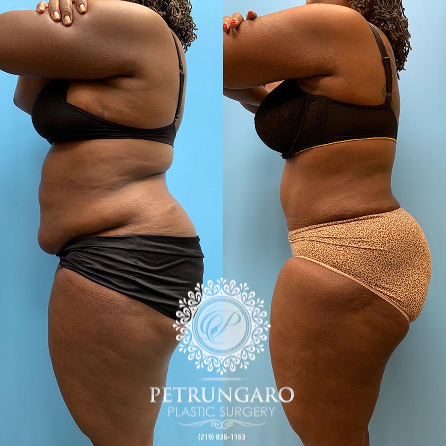 49 year old woman 4 months after Tummy Tuck with Lipo 360-2