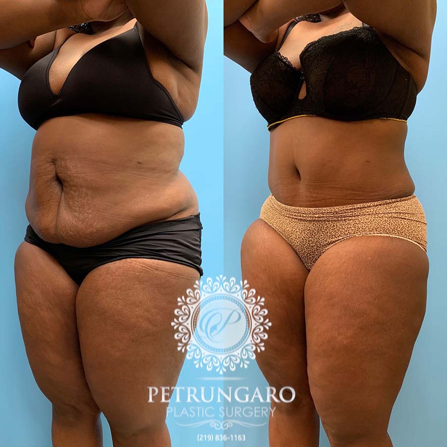 49 year old woman 4 months after Tummy Tuck with Lipo 360-5