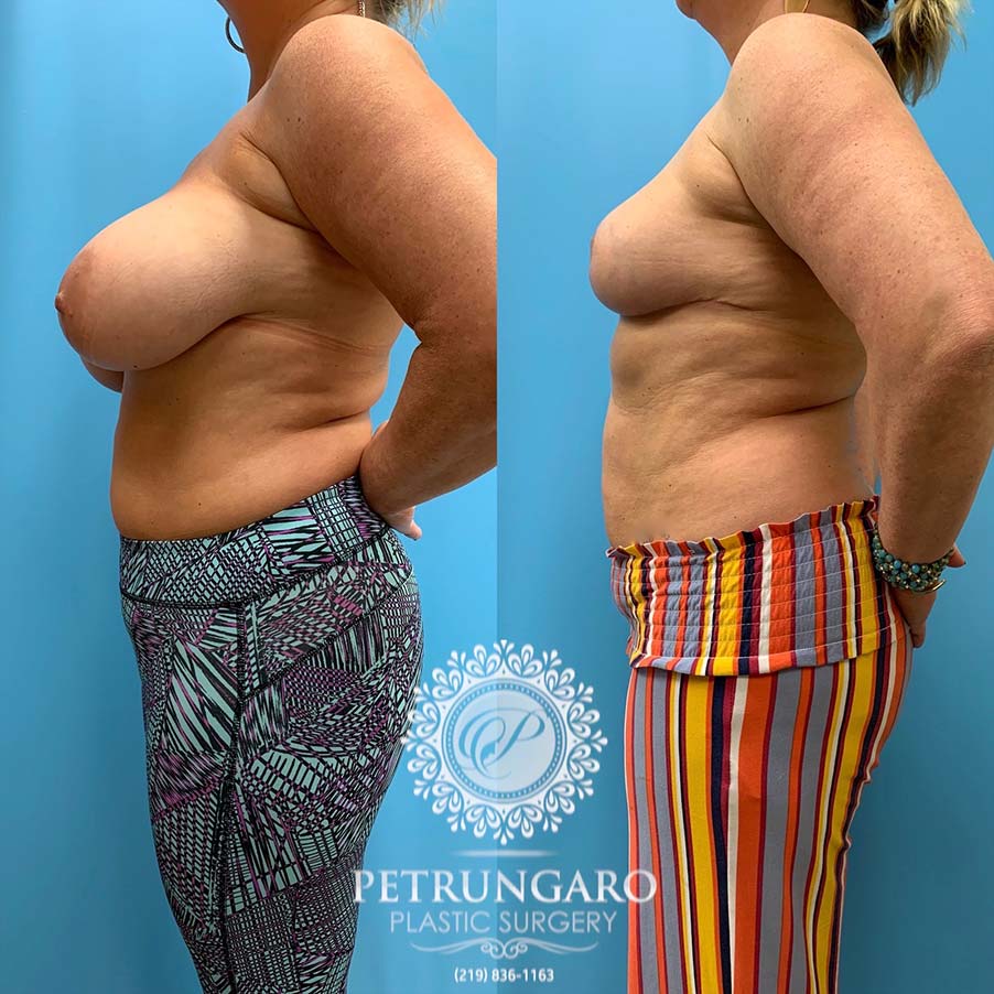 50 year old woman 3 months after Breast Reduction -2