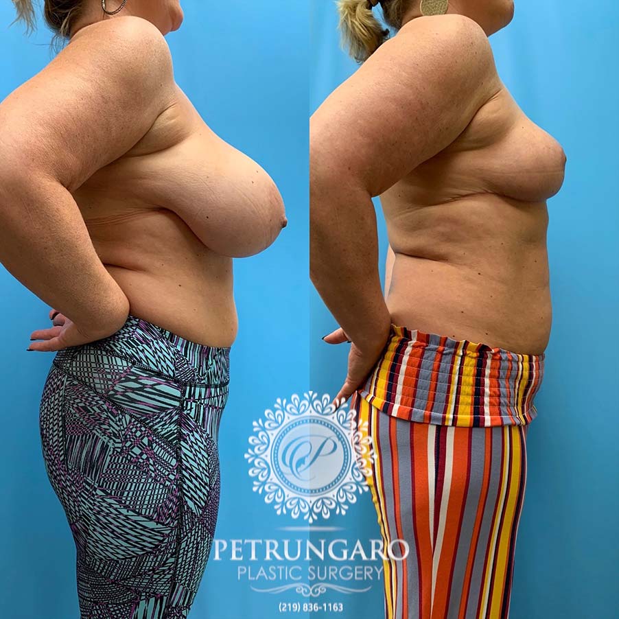50 year old woman 3 months after Breast Reduction -3
