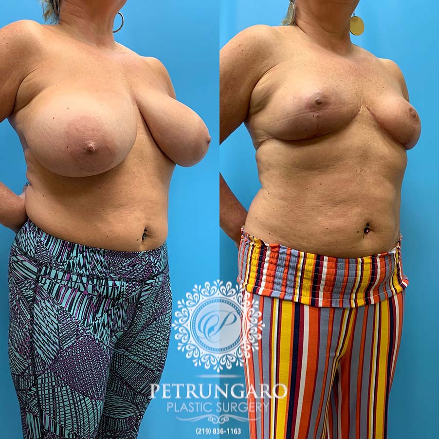 50 year old woman 3 months after Breast Reduction -4