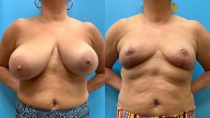 50 year old woman 3 months after Breast Reduction -f