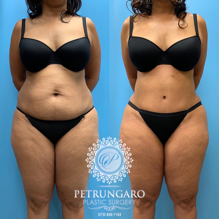 54 year old woman 4 months after Tummy Tuck with Lipo 360-2