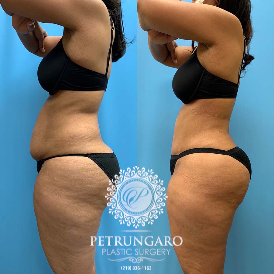 54 year old woman 4 months after Tummy Tuck with Lipo 360-3