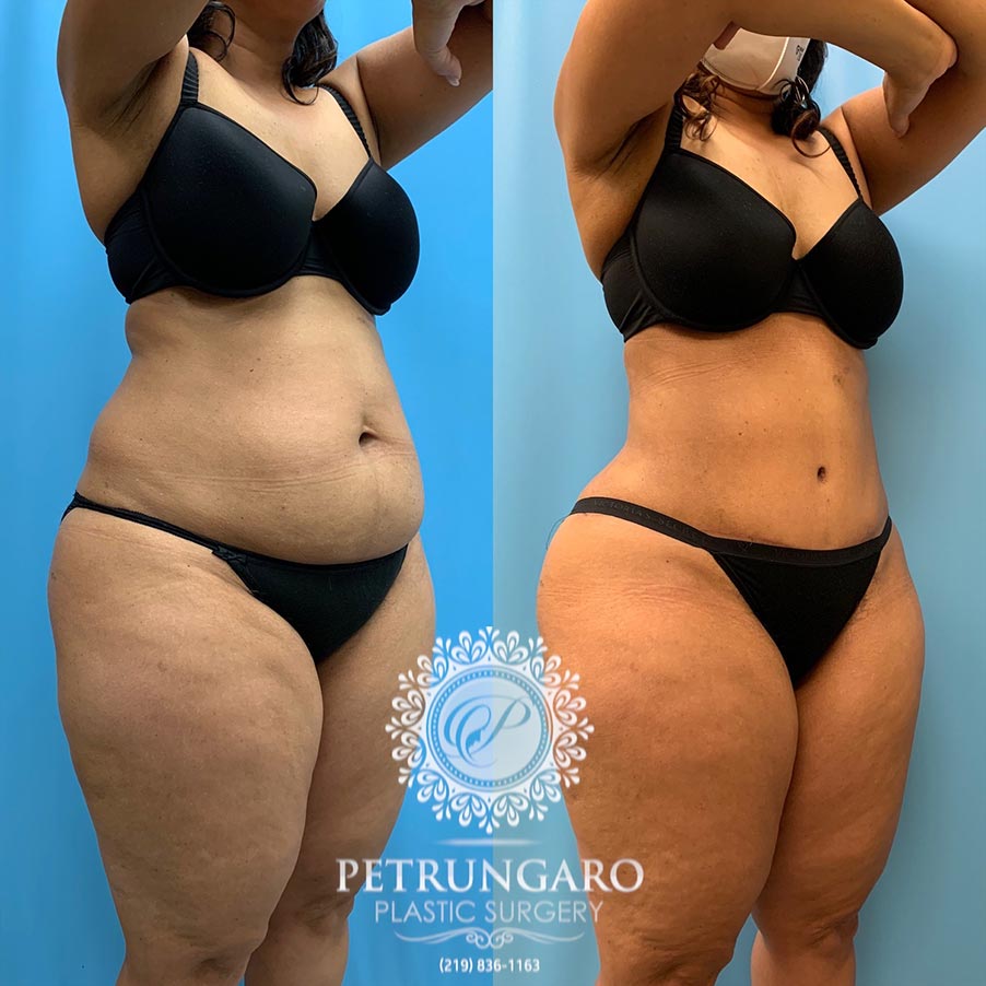 54 year old woman 4 months after Tummy Tuck with Lipo 360-4