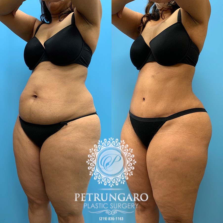 54 year old woman 4 months after Tummy Tuck with Lipo 360-5