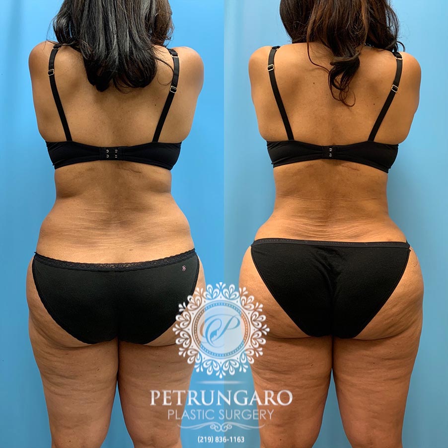 54 year old woman 4 months after Tummy Tuck with Lipo 360-6