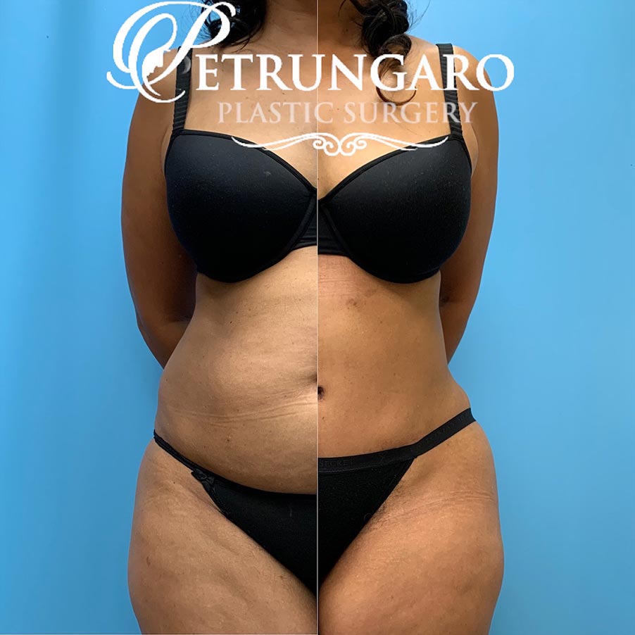 54 year old woman 4 months after Tummy Tuck with Lipo 360-7