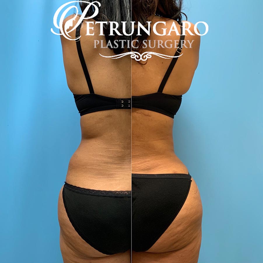 54 year old woman 4 months after Tummy Tuck with Lipo 360-8