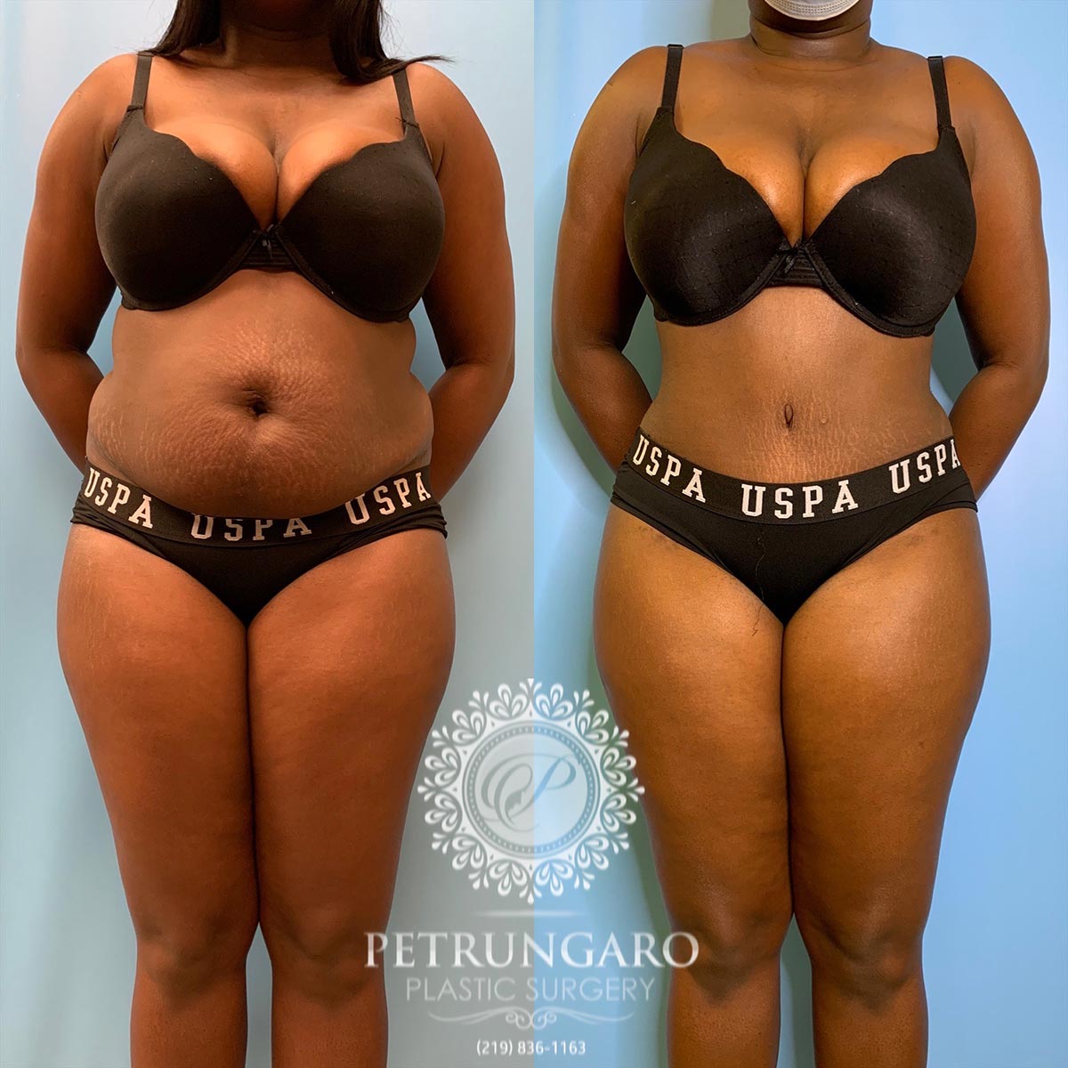 30 year old woman 3 months after tummy tuck with Lipo 360-1
