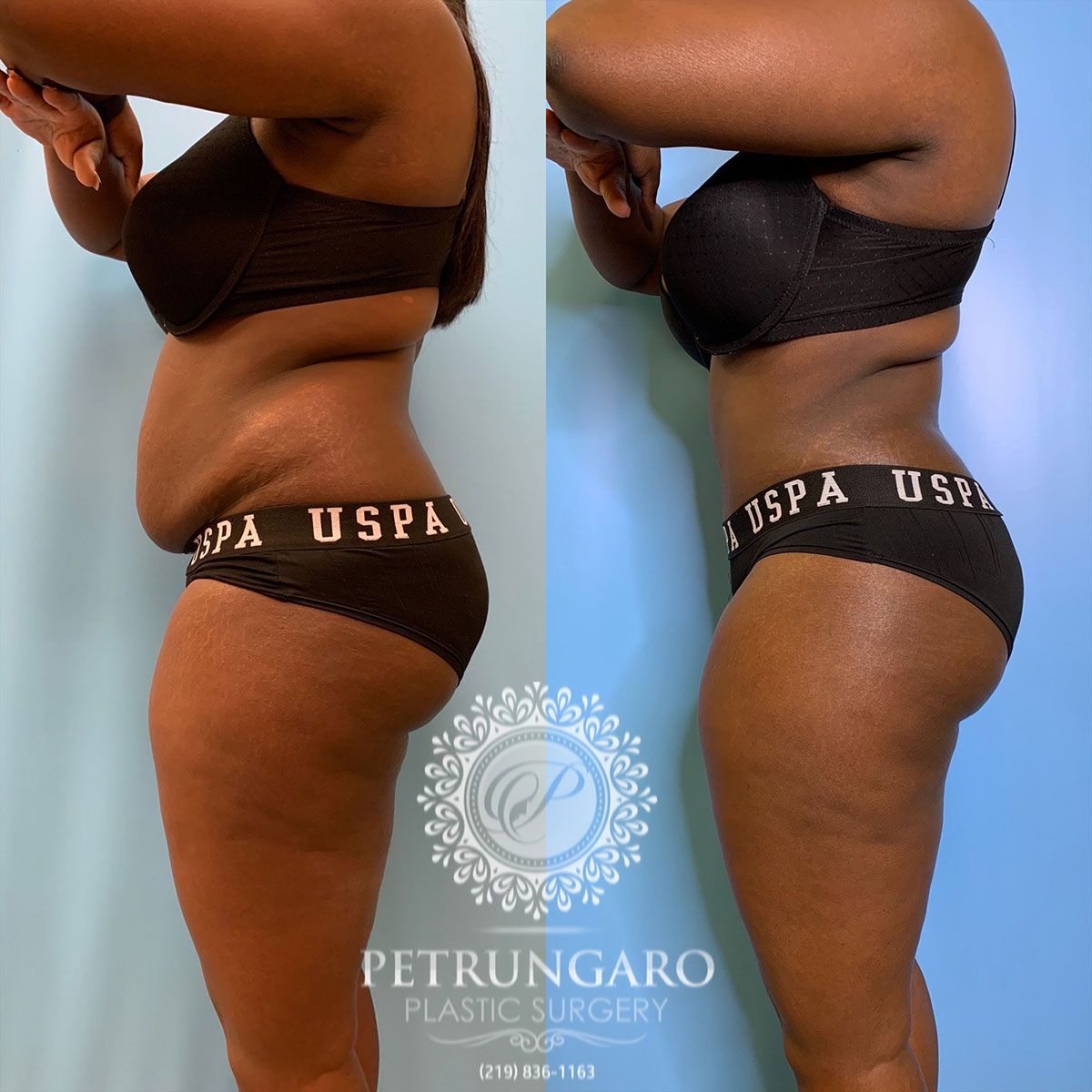 30 year old woman 3 months after tummy tuck with Lipo 360-2
