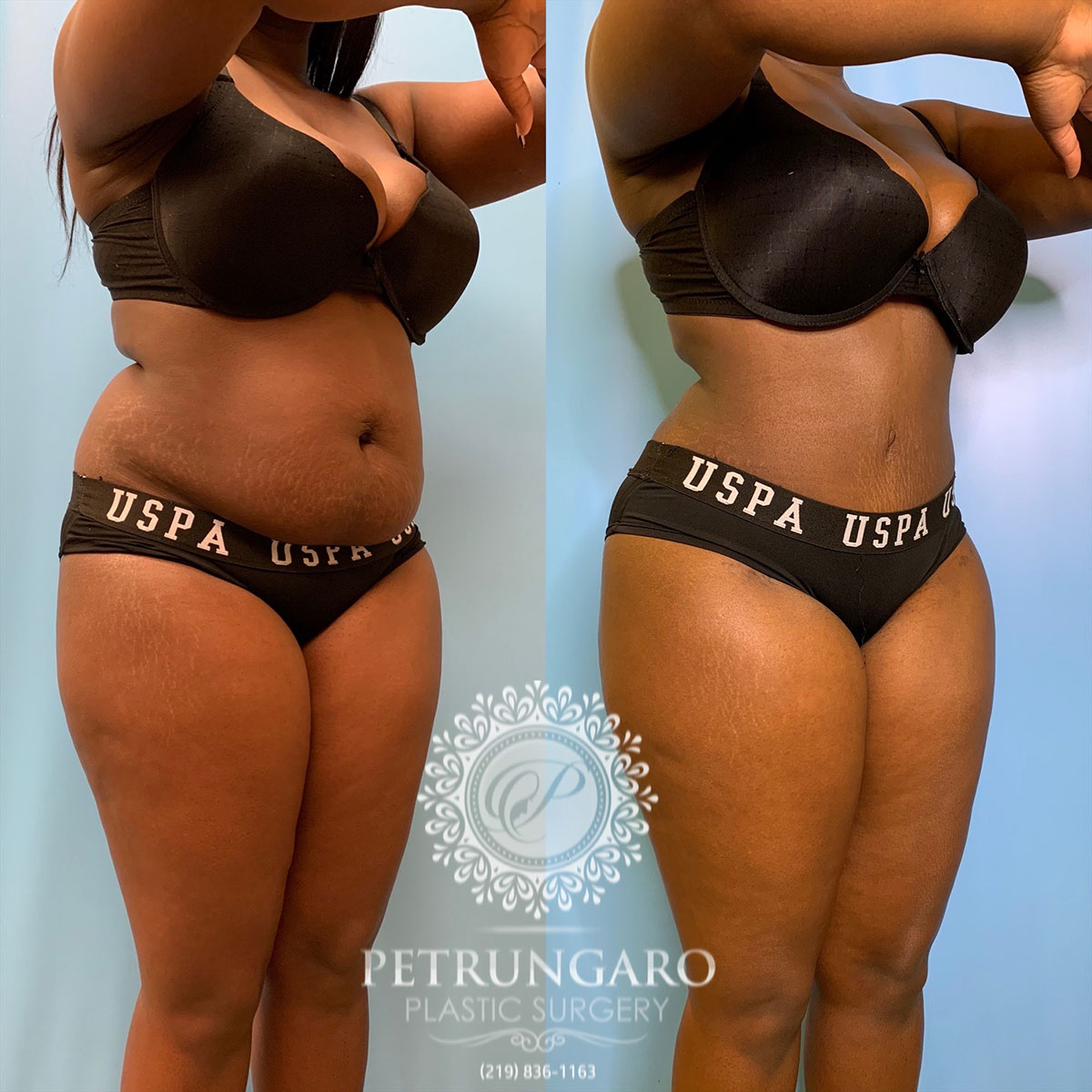 30 year old woman 3 months after tummy tuck with Lipo 360-4