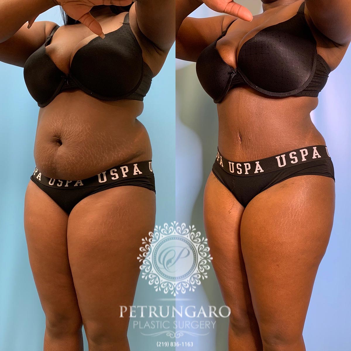 30 year old woman 3 months after tummy tuck with Lipo 360-5