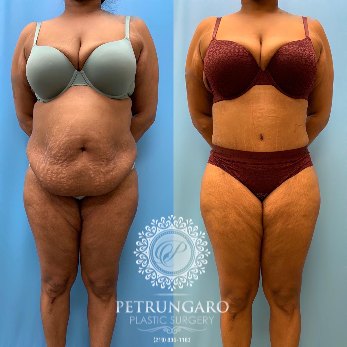 37 year old woman 3 months after tummy tuck with Lipo 360-1