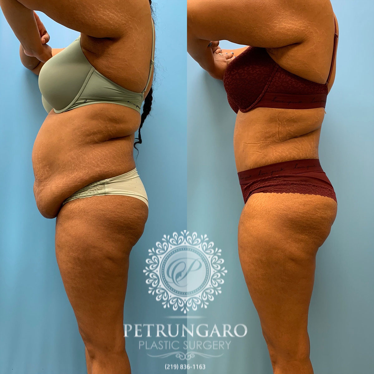37 year old woman 3 months after tummy tuck with Lipo 360-2