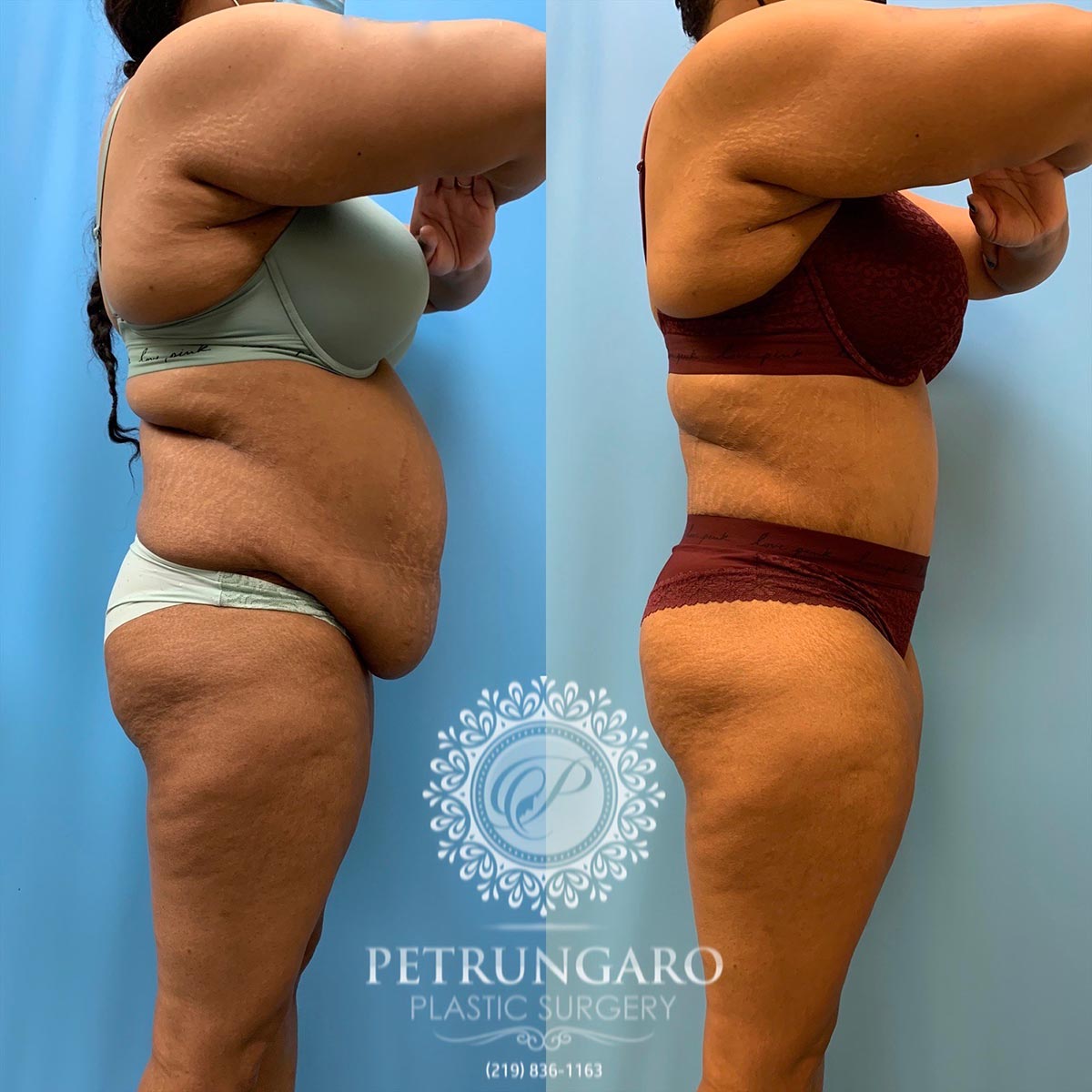 37 year old woman 3 months after tummy tuck with Lipo 360-3