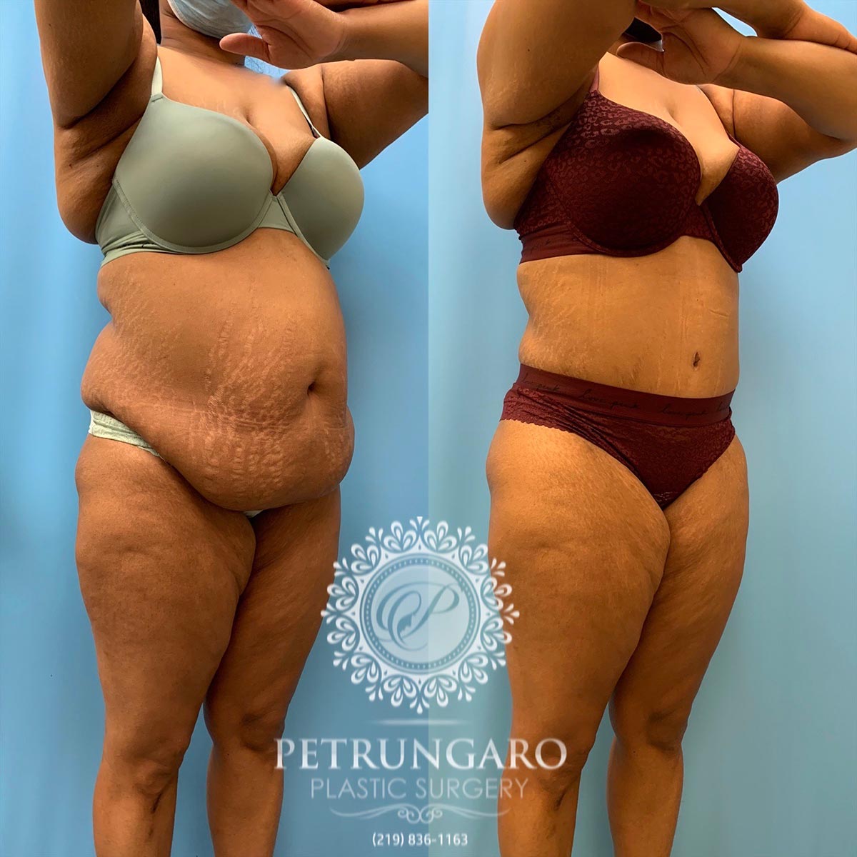 37 year old woman 3 months after tummy tuck with Lipo 360-4