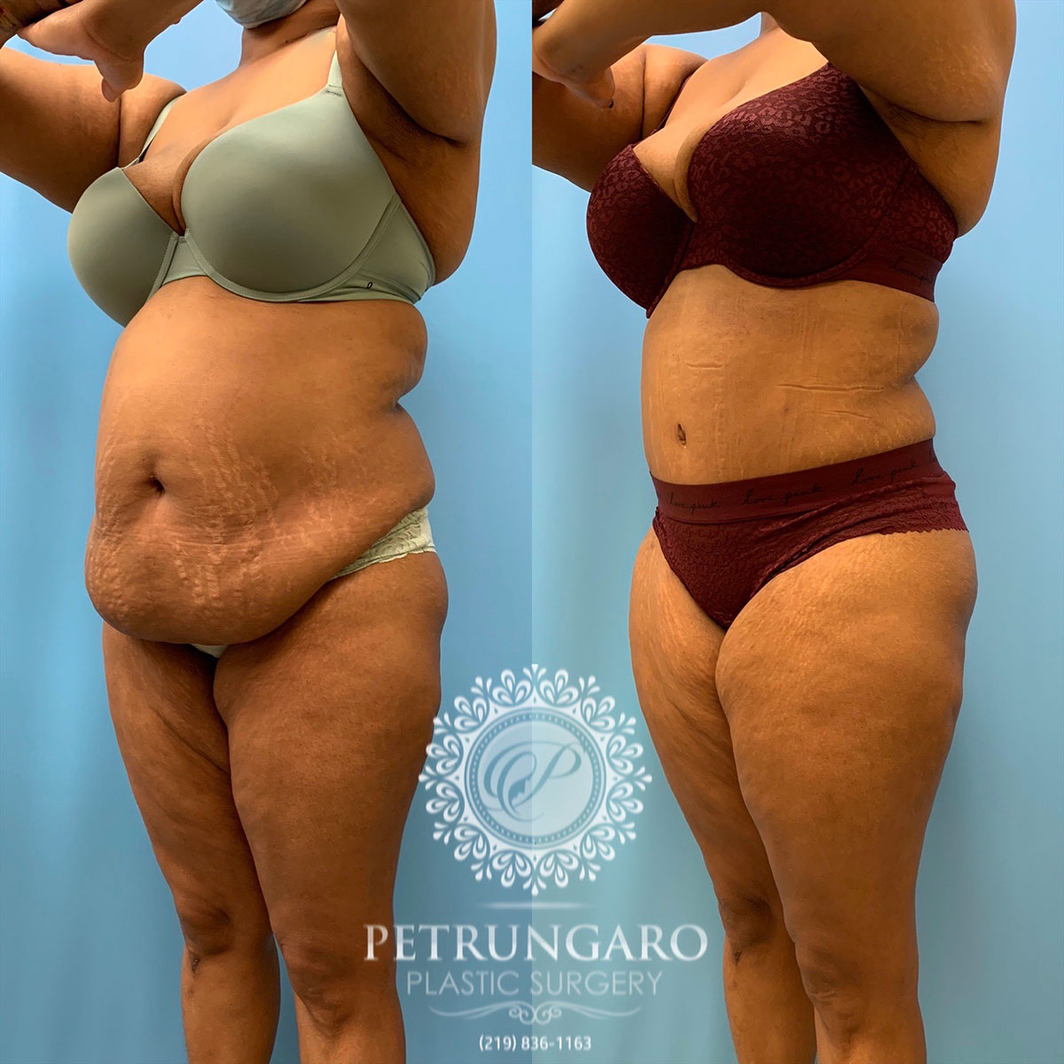 37 year old woman 3 months after tummy tuck with Lipo 360-5