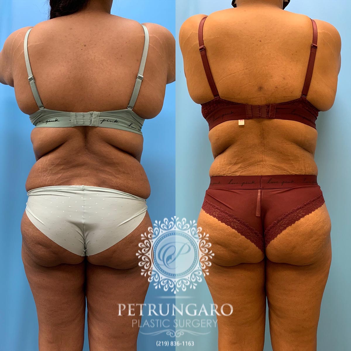 37 year old woman 3 months after tummy tuck with Lipo 360-6