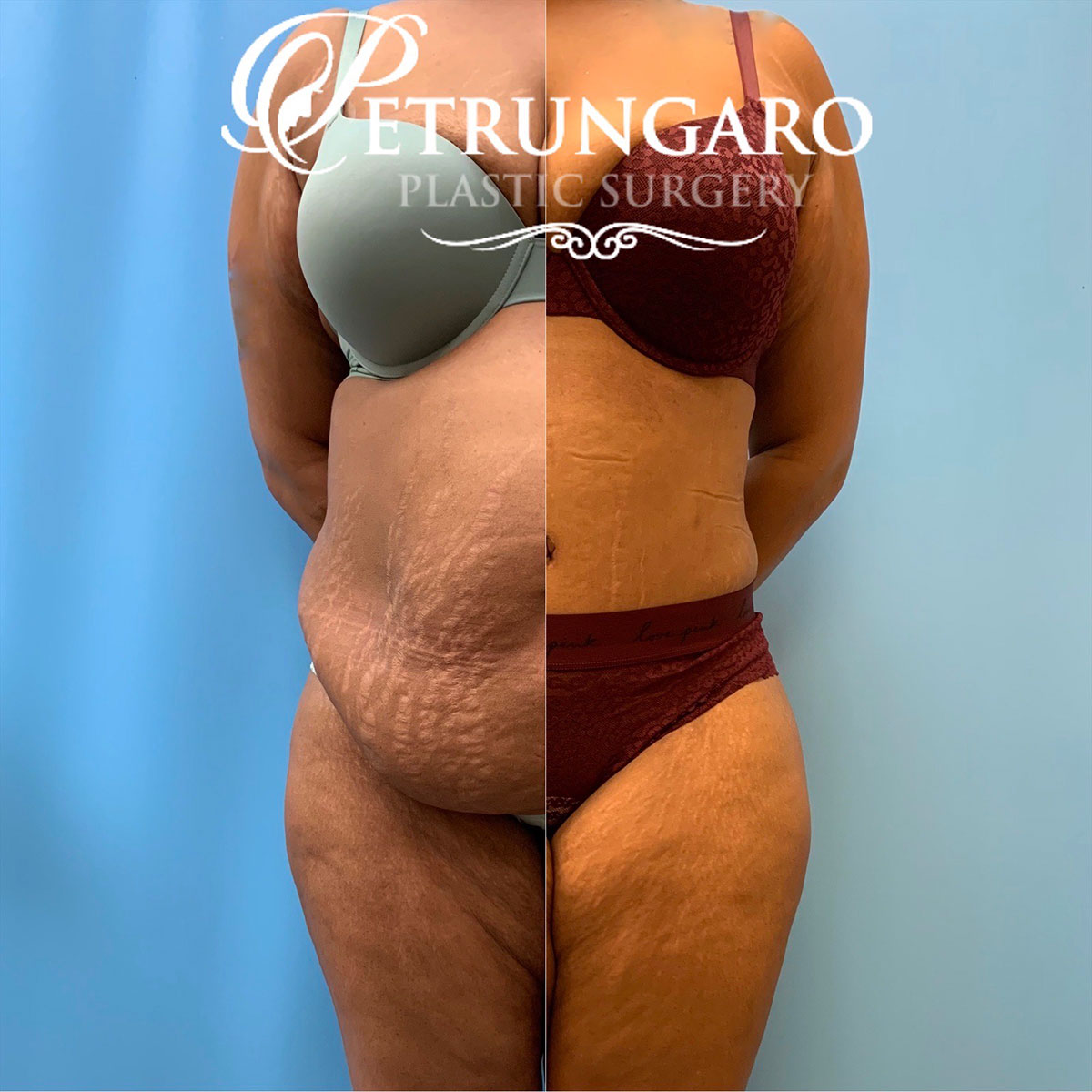 37 year old woman 3 months after tummy tuck with Lipo 360-7