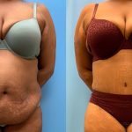 37 year old woman 3 months after tummy tuck with Lipo 360-f