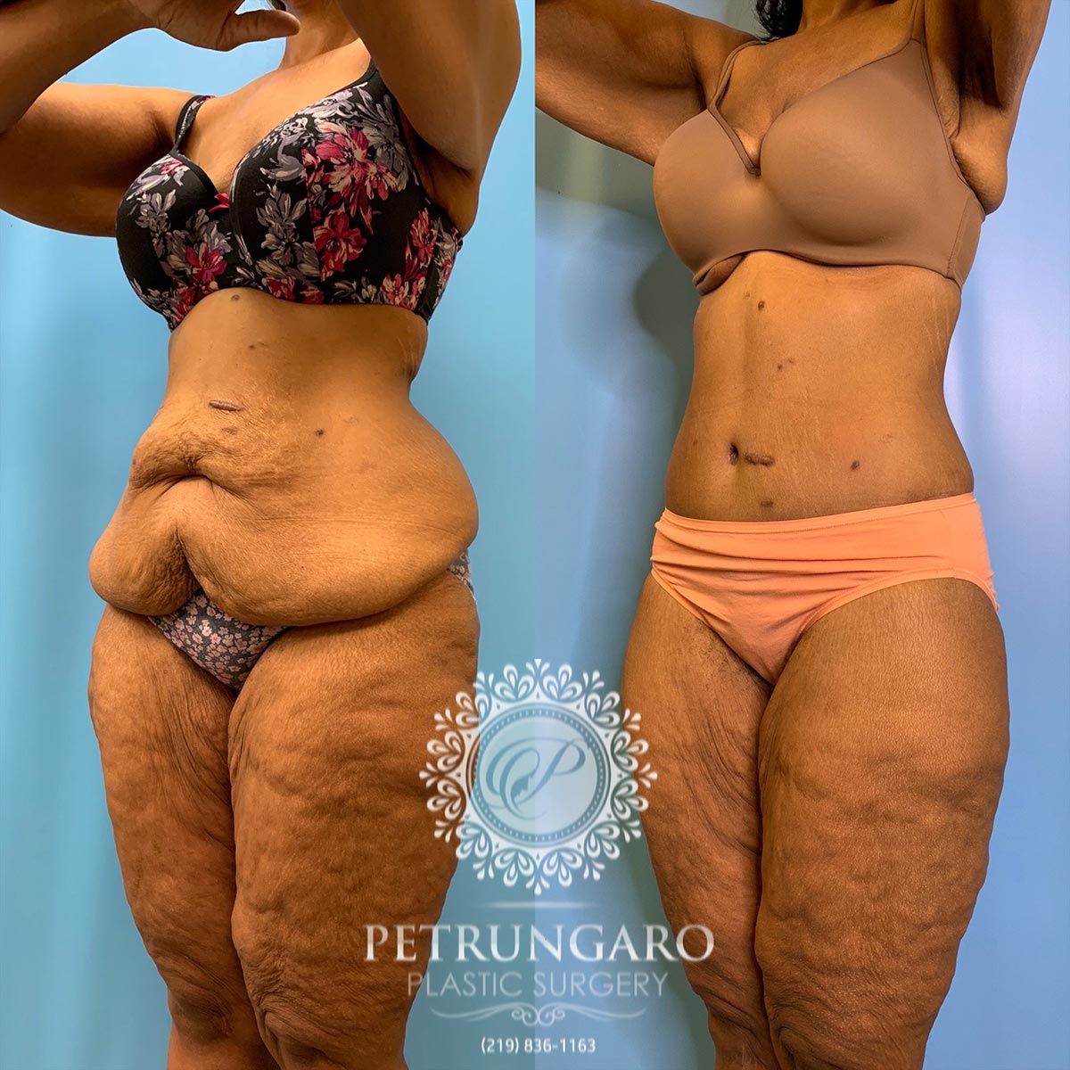42 year old woman 3 months after a circumferential body lift-5