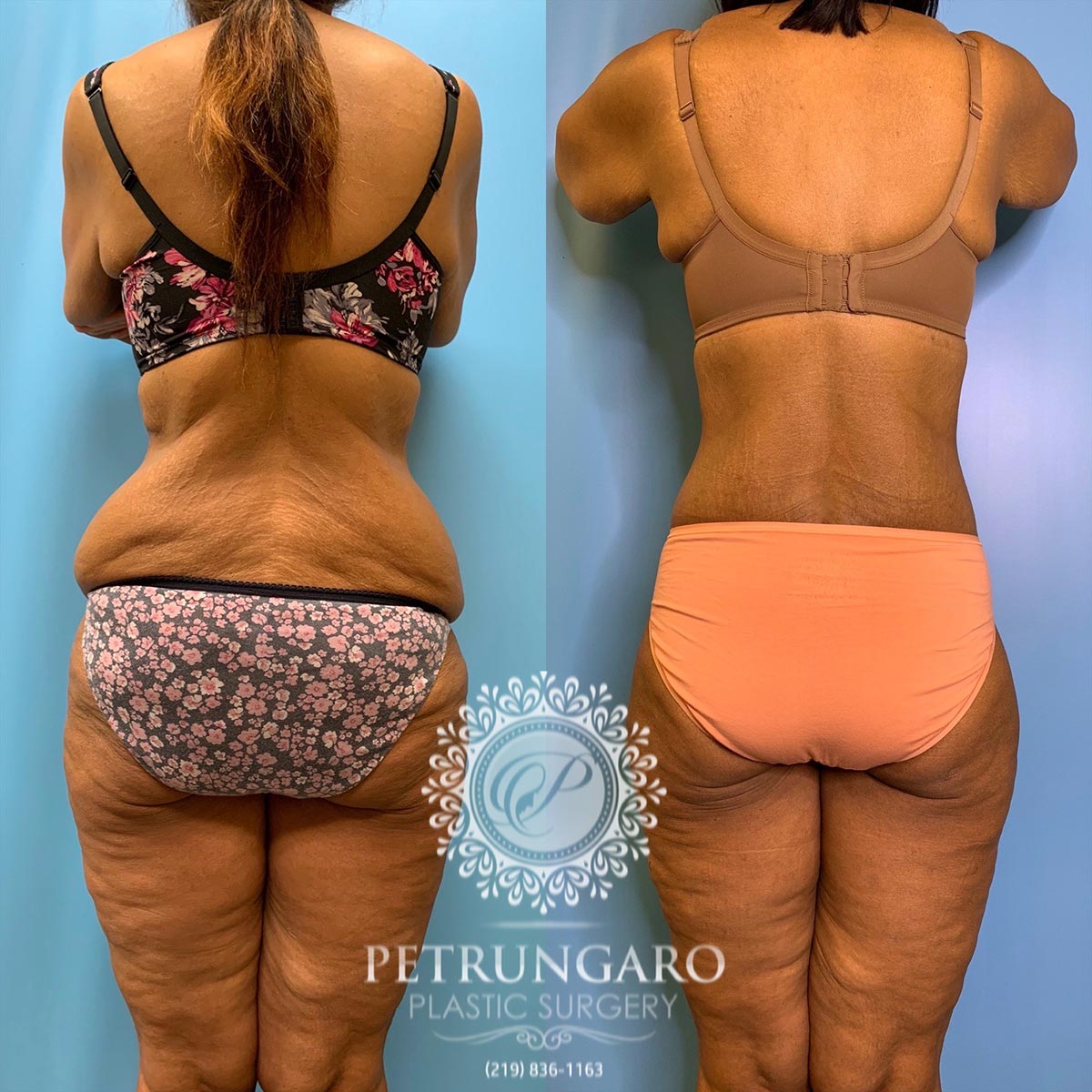 42 year old woman 3 months after a circumferential body lift-6