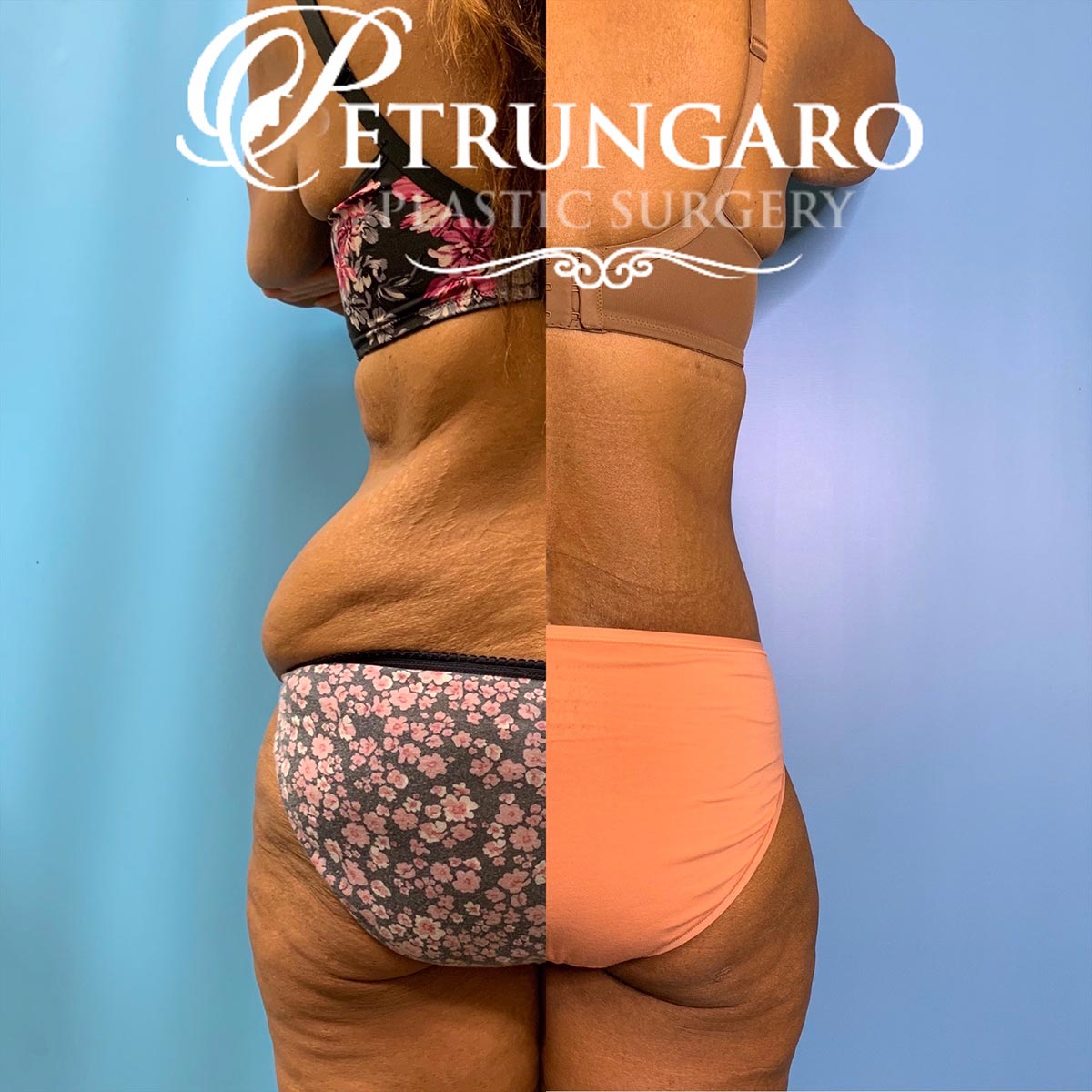 42 year old woman 3 months after a circumferential body lift-7
