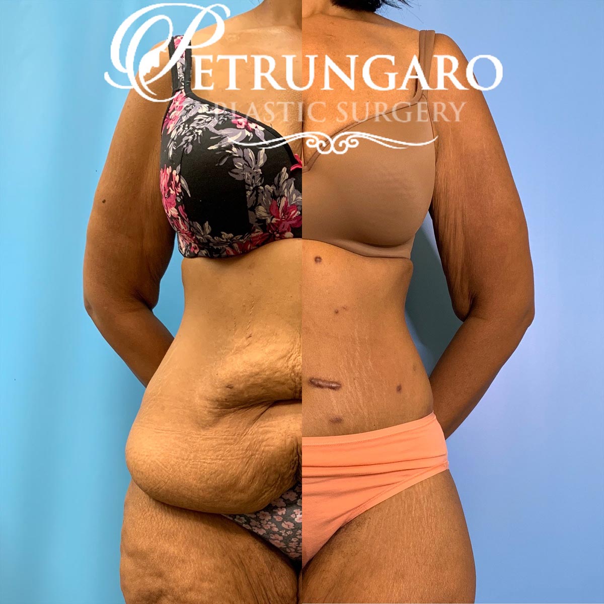 42 year old woman 3 months after a circumferential body lift-8