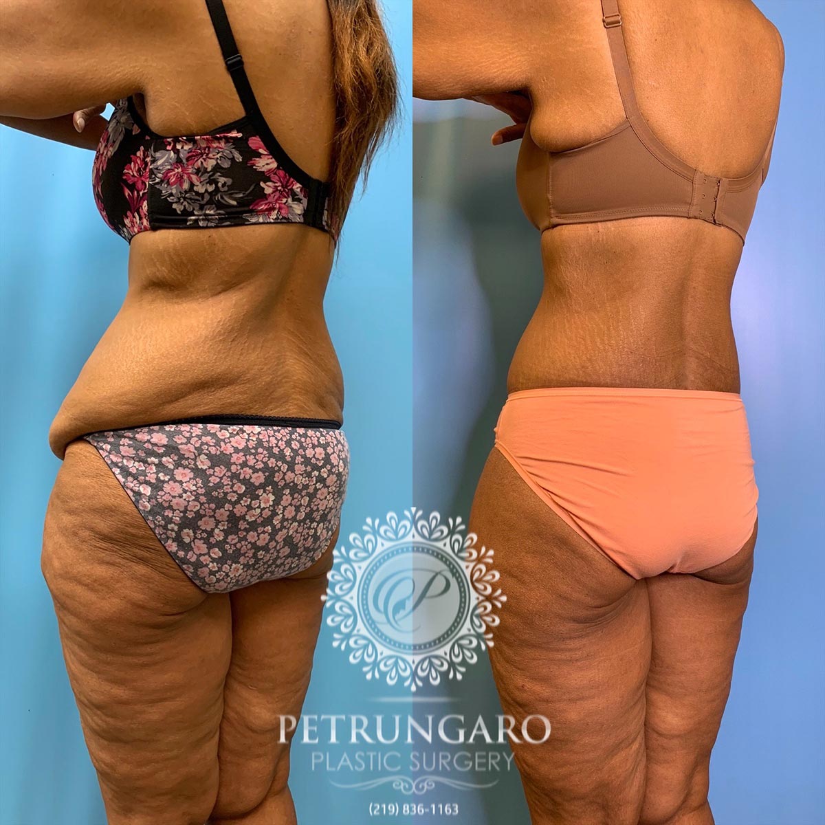 42 year old woman 3 months after a circumferential body lift-9