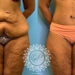 42 year old woman 3 months after a circumferential body lift-f