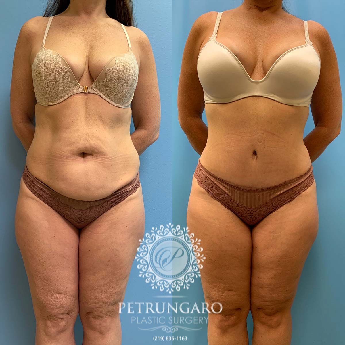 49 year old woman three months after tummy tuck with Lipo 360-1