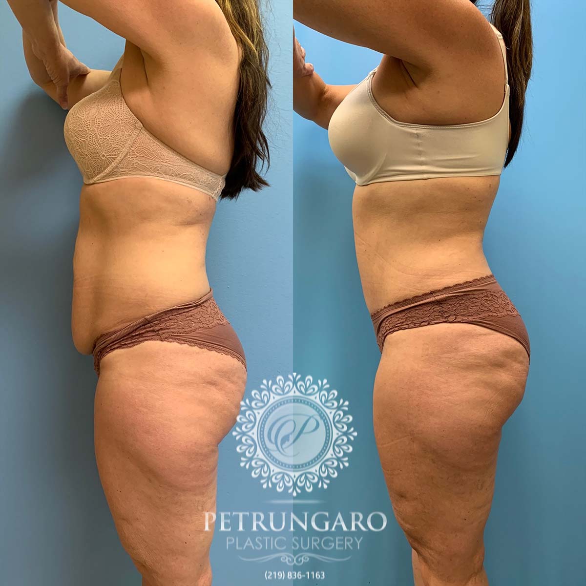 49 year old woman three months after tummy tuck with Lipo 360-2