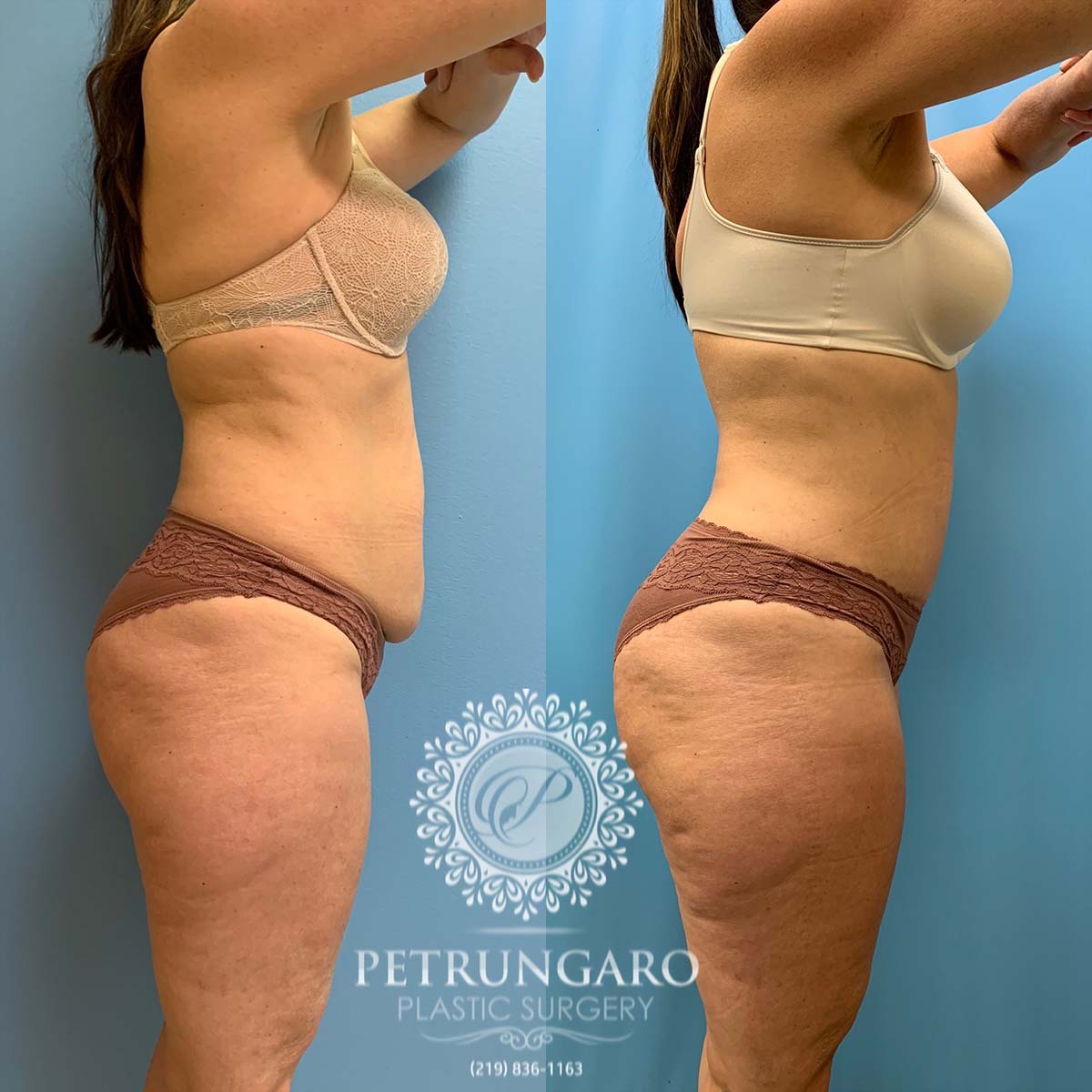 49 year old woman three months after tummy tuck with Lipo 360-3