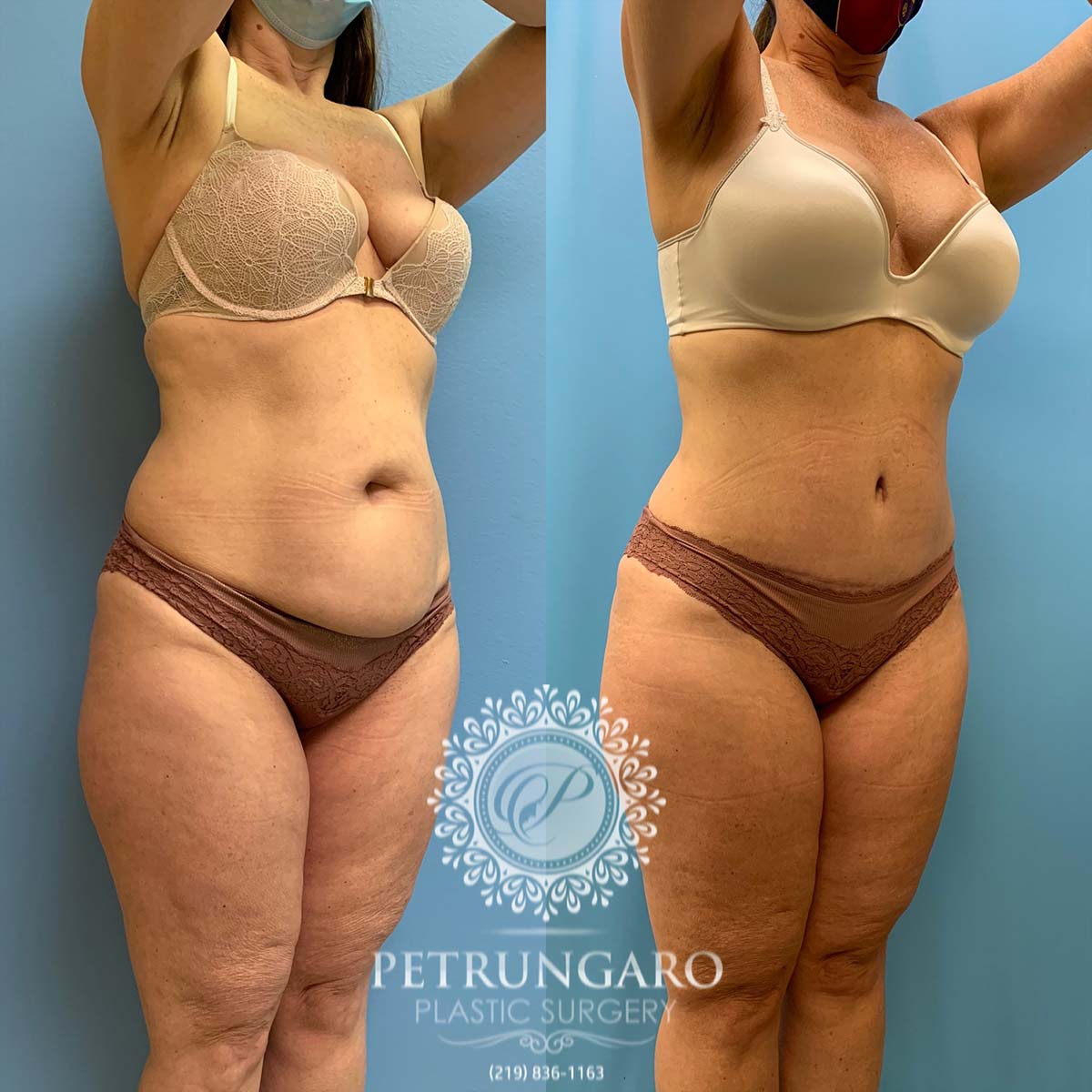 49 year old woman three months after tummy tuck with Lipo 360-4