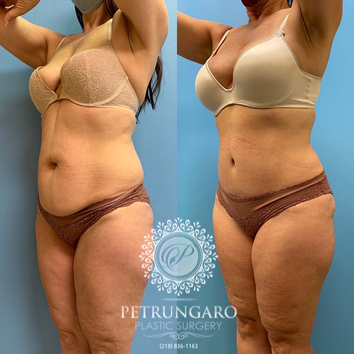 49 year old woman three months after tummy tuck with Lipo 360-5