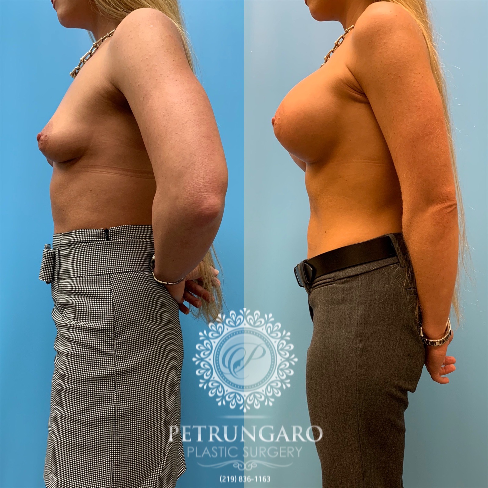 31 year old woman 3 months after breast augmentation-2