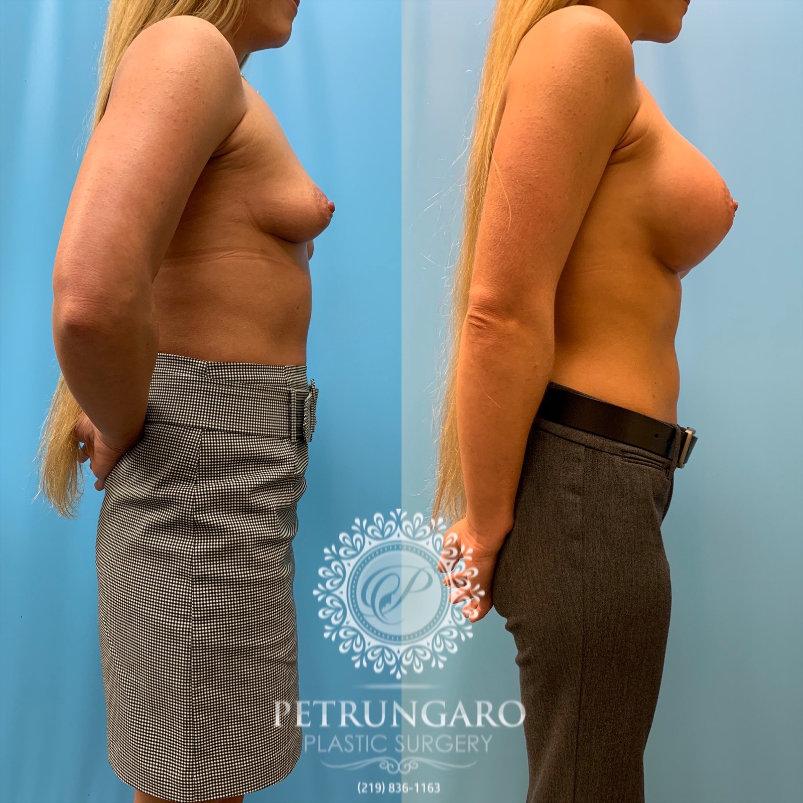 31 year old woman 3 months after breast augmentation-3