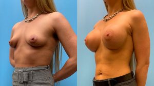 31 year old woman 3 months after breast augmentation-f