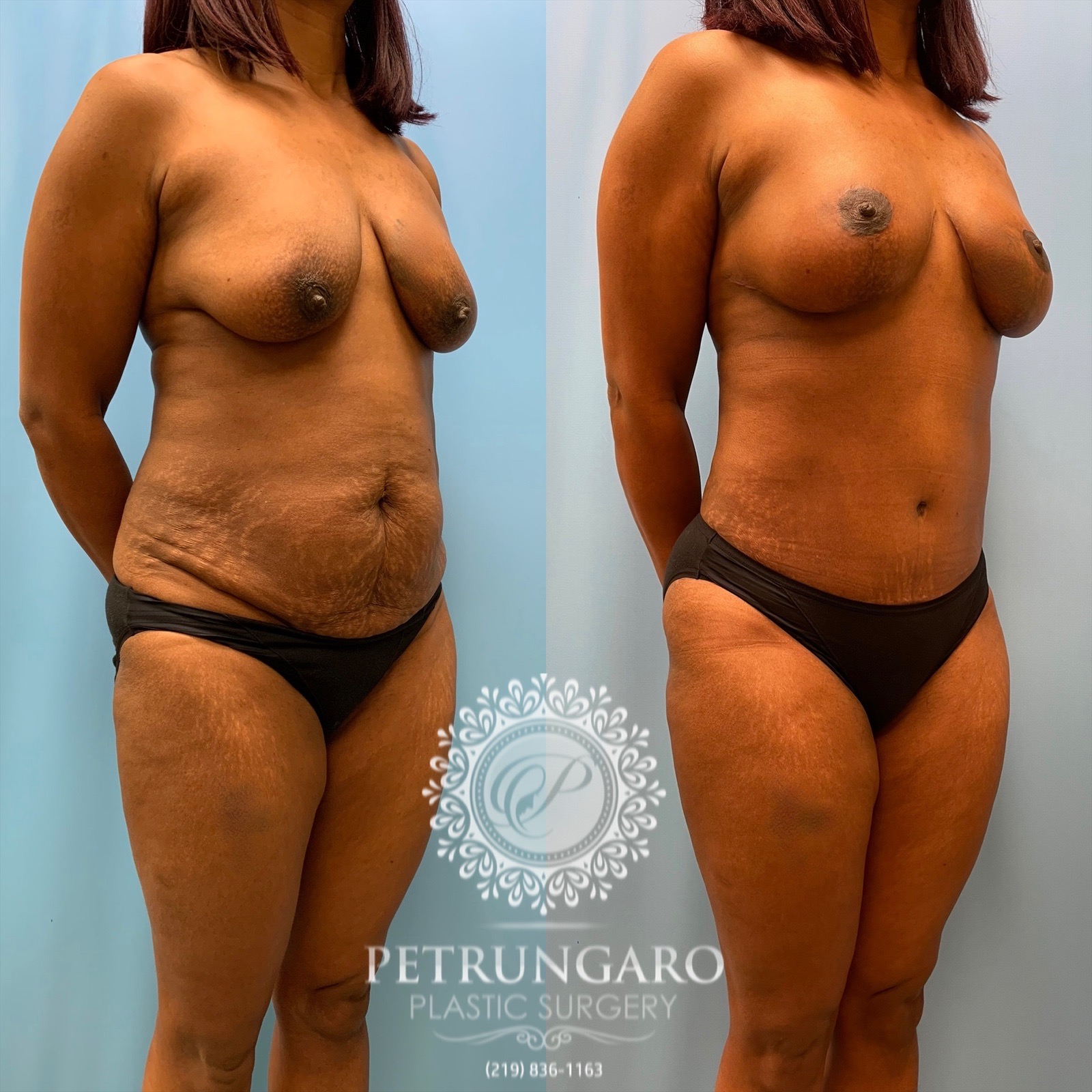 43 year old woman 3 months after Mommy Makeover-4