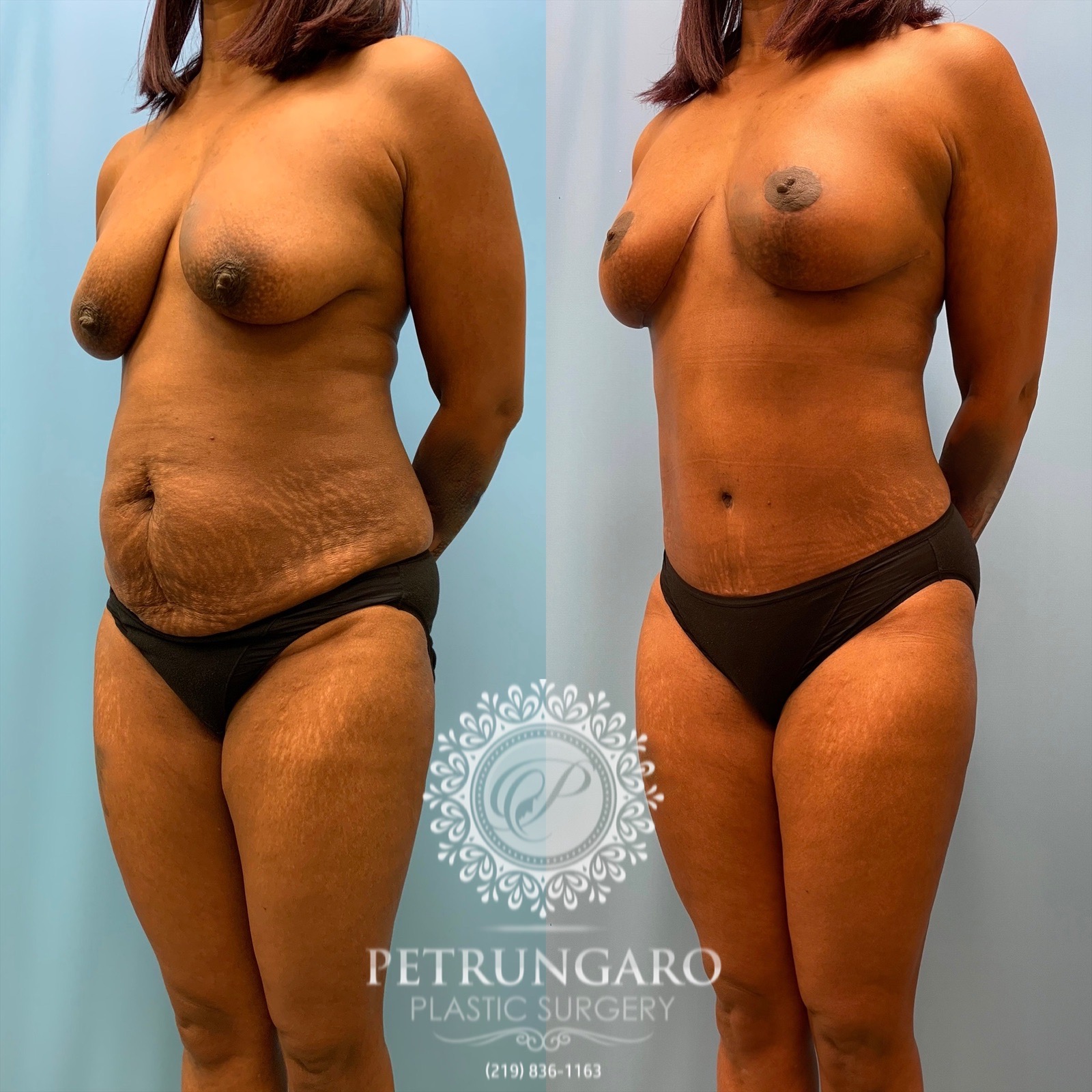 43 year old woman 3 months after Mommy Makeover-5