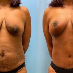 43 year old woman 3 months after Mommy Makeover-f