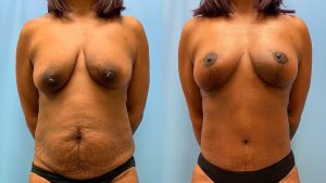 43 year old woman 3 months after Mommy Makeover-f