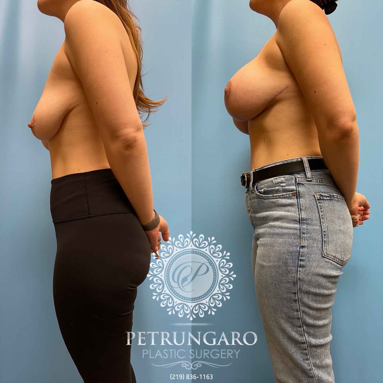 anchor-pattern-breast-lift-implants-natrelle-inspira-before-after-2