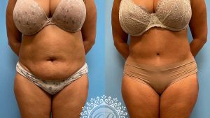 tummy-tuck-lipo-before-after-111-feature
