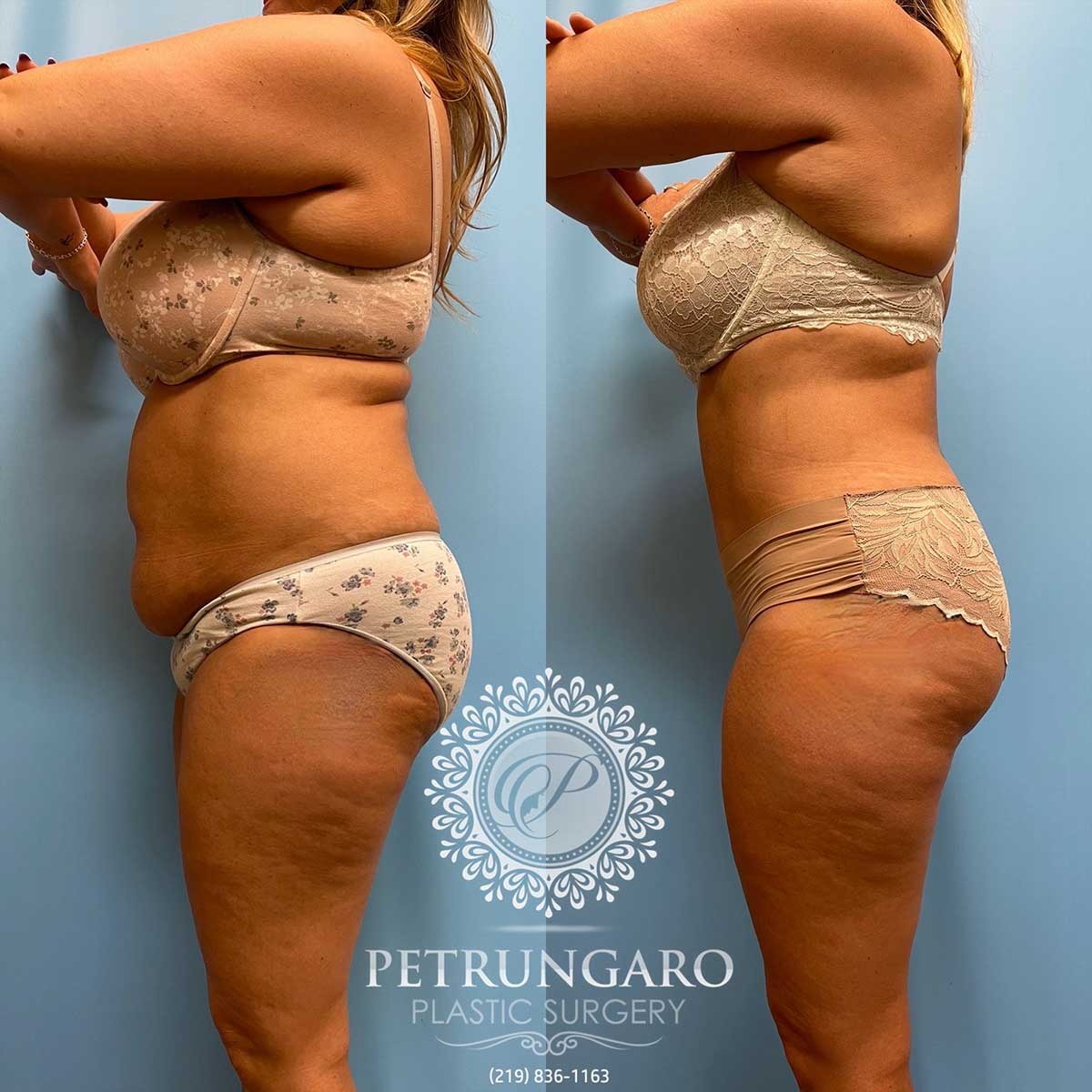 tummy-tuck-lipo-before-after-112