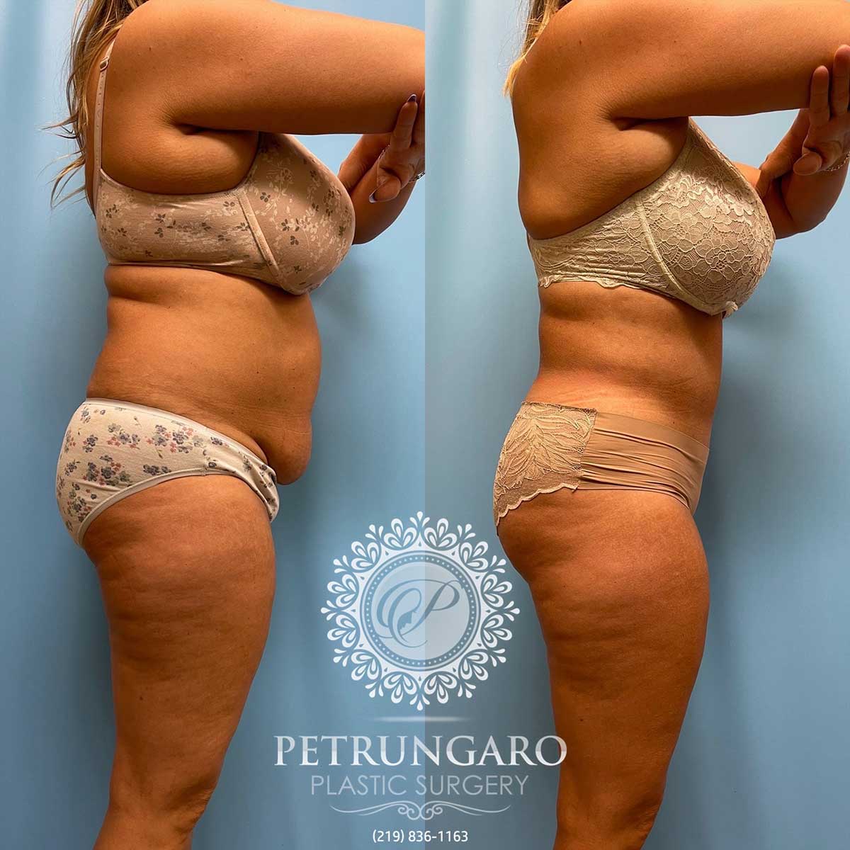 tummy-tuck-lipo-before-after-113
