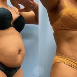 tummy-tuck-with-lipo-360-featured-2