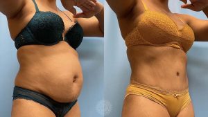 tummy-tuck-with-lipo-360-featured-2